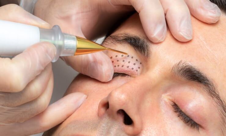 Холодная плазма в косметологии