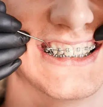 How much time is it worth wearing braces?