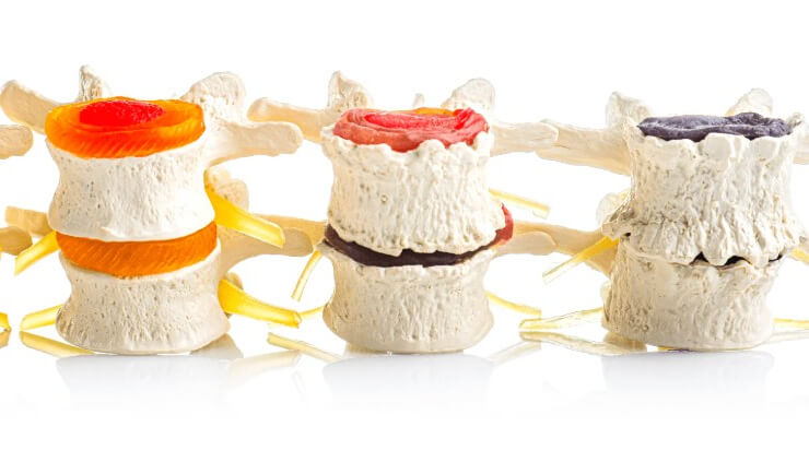 Может ли остеохондроз пройти сам? Что говорит доказательная медицина