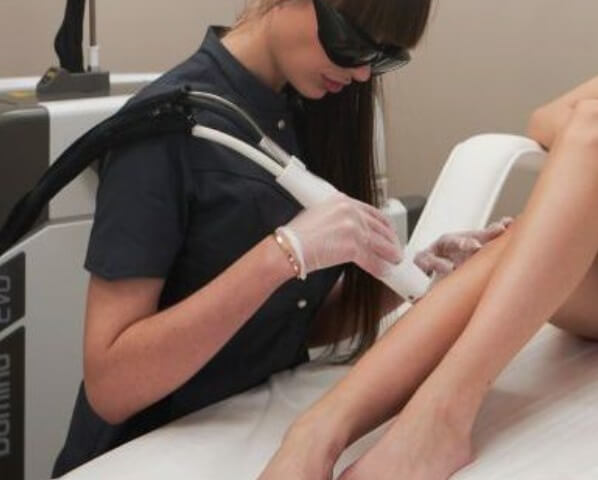 Laser hair removal of the lower leg and buttocks